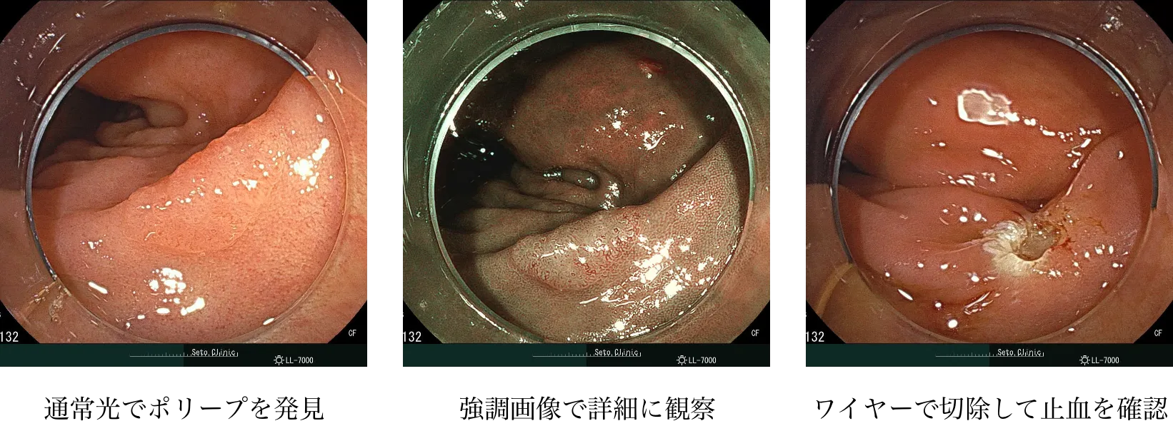 大腸内視鏡検査